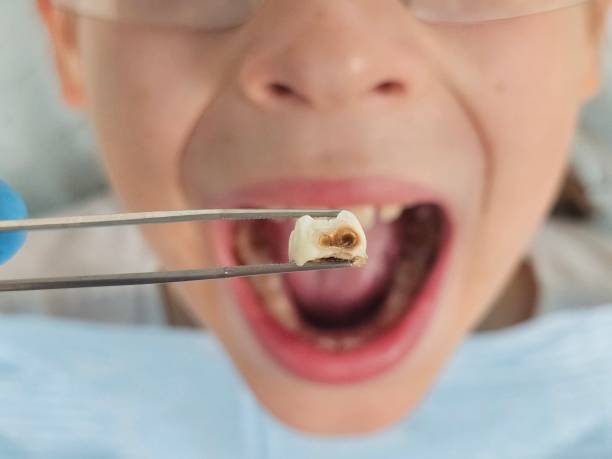 Best Emergency Tooth Extraction in Avon Lake, OH